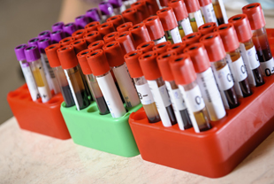 Medical test-tube with blood samples
